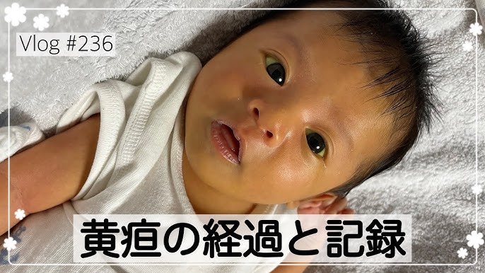 生後1ヶ月 赤ちゃん 黄疸の写真素材12286425- PIXTA