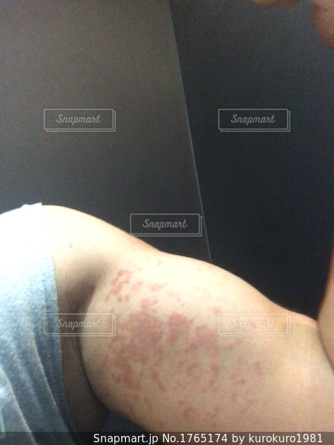 皮膚画像検索 │ ひふ研 「ひふ症状、ひふ薬の使い方の疑問に答える情報サイト」 │ 第一三共ヘルスケア