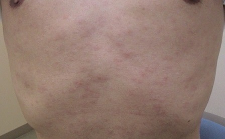 梅毒の検査と治療について、費用と治療期間 - 横浜・渋谷・名古屋・札幌・大阪梅田の性感染症内科ペアライフクリニック