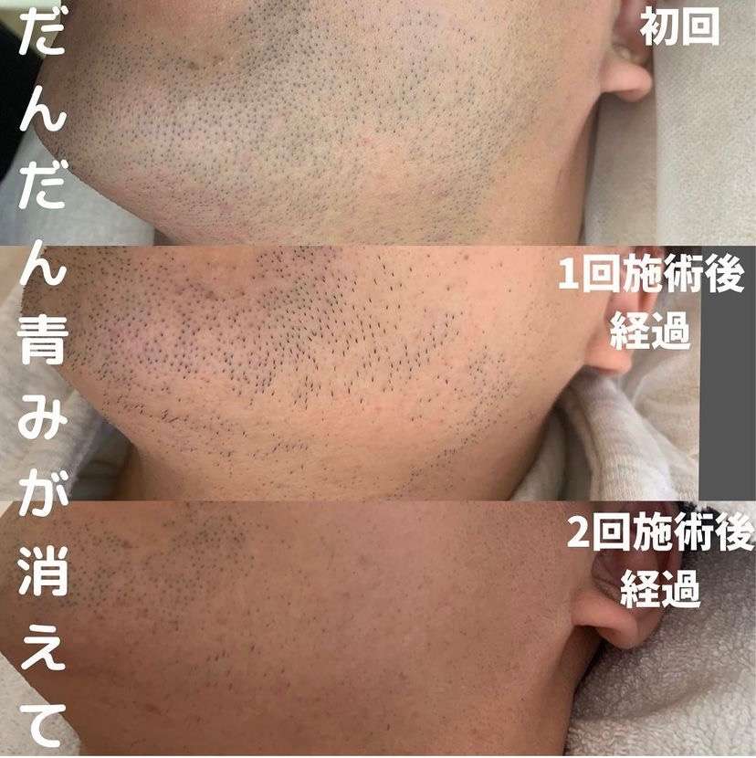 Qoo10脱毛器 女性 光美容器 vio対応 メン