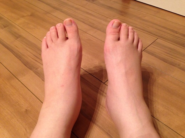 足の水膨れ 水疱AKIKOさんのブログ - @cosme アットコスメ