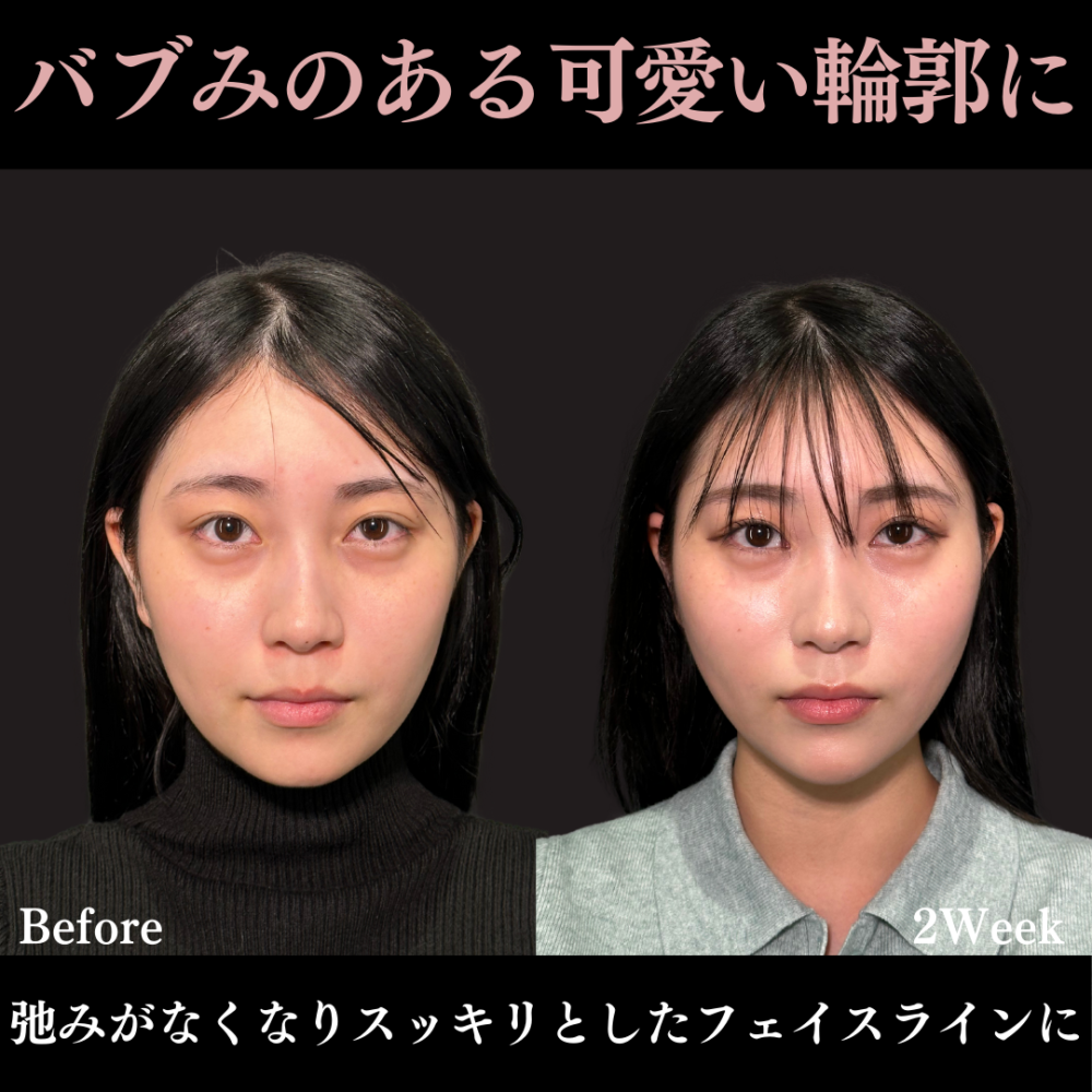 プチ小顔術 ボツリヌス・トキシン注入品川美容外科 公式