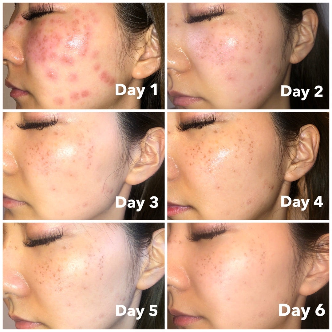 シミ取りレーザーシミ取り放題- 銀座・名古屋・心斎橋の美肌治療は椿クリニック