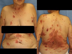 水虫・爪水虫 - みやた皮膚科クリニック松戸駅 徒歩2分の皮膚科專門クリニック 脱毛 アトピー性皮膚炎,ニキビなど治療