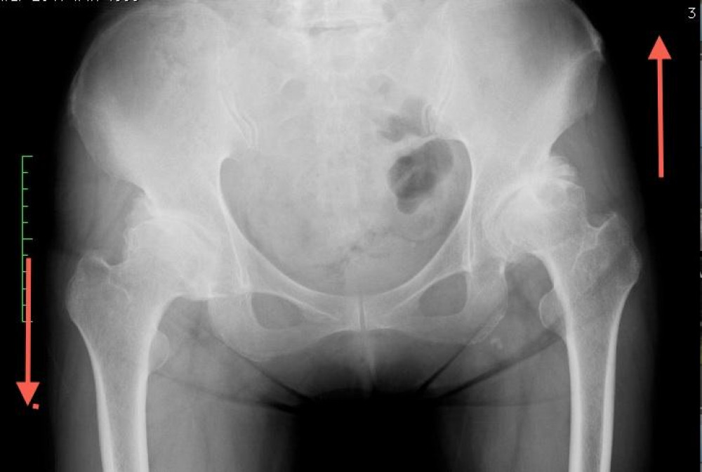 トリセツ レントゲン撮説～下腿骨のレントゲン～issy