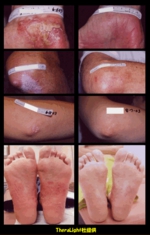 Hospitalist ~なんでも無い科医の勉強ノート~: ステロイド局所注射による色素脱失