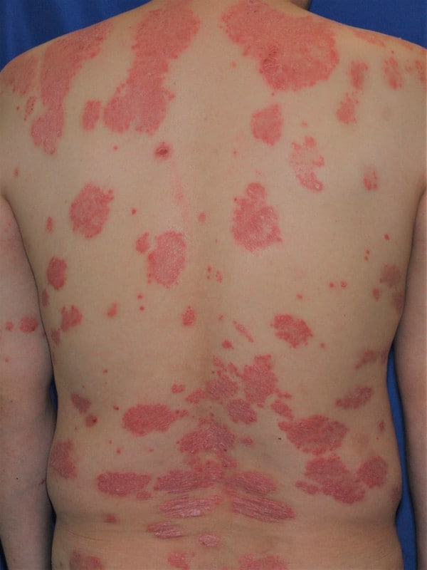 自由が丘の皮膚科医が解説：梅毒の症状・検査・治療