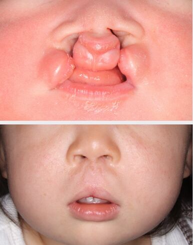 鹿児島大学 口唇口蓋裂専門外来