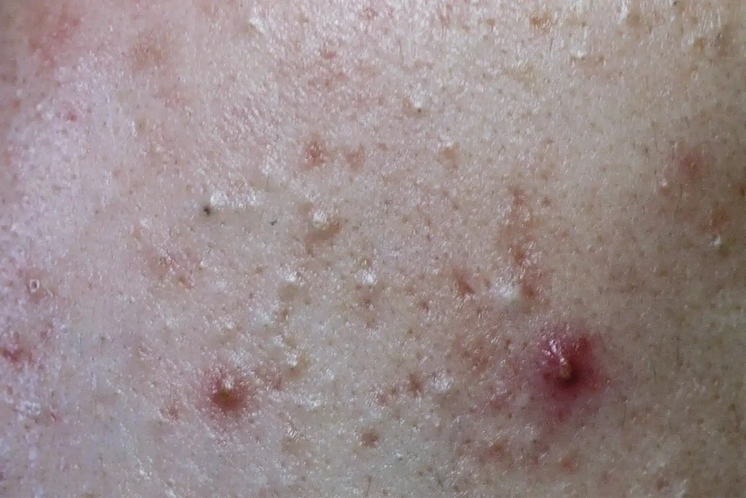 首に出来物ができました。大きなニキビのような感じで、赤く腫れ上がってま- Yahoo!知恵袋