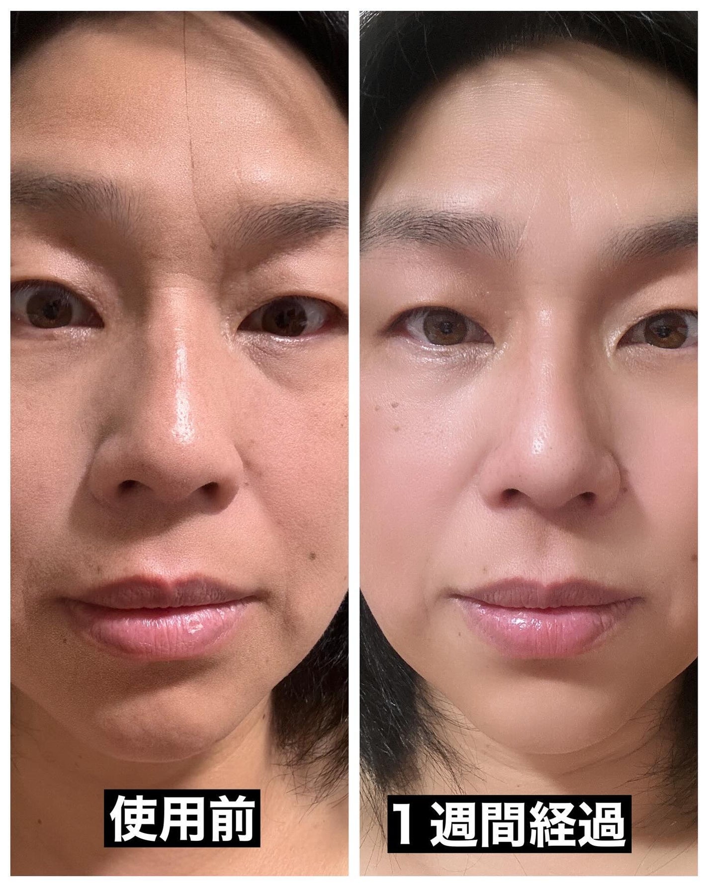 楽天市場 ルクセア 鼻 美顔器 フォーネス ☆最大3,000円クーポン☆ 鼻専用美顔器 Fornez フォーネス 鼻専用 EMS 美顔器 ルクセアフォーネス LUXCEAR ノーズクリップ LUXCEAR Fornez 送料無料 鼻 ルクセア 鼻用美顔器 忘れ鼻 高く Eライン 鼻クリップ 鼻矯正 RSL発送