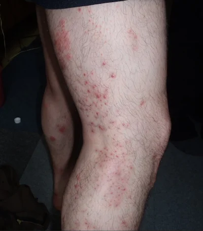 やあ、みんな、これなんだかわかる人いる？噛まれた跡が何かわからなくて。ここが正しいサブなのかわからないけど、フィンランドで起きたことだから、もしかしたら知ってる人がいるかなって。ダニじゃないかちょっと心配。背の高い草の中を歩いたんだ。: r Finland