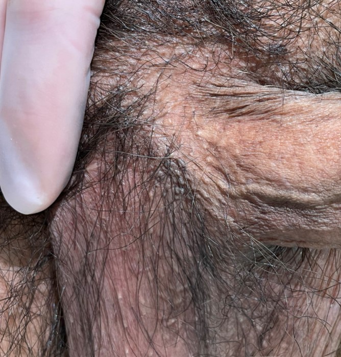 尖圭コンジローマとは？原因・症状・治療など新宿駅前クリニック泌尿器科