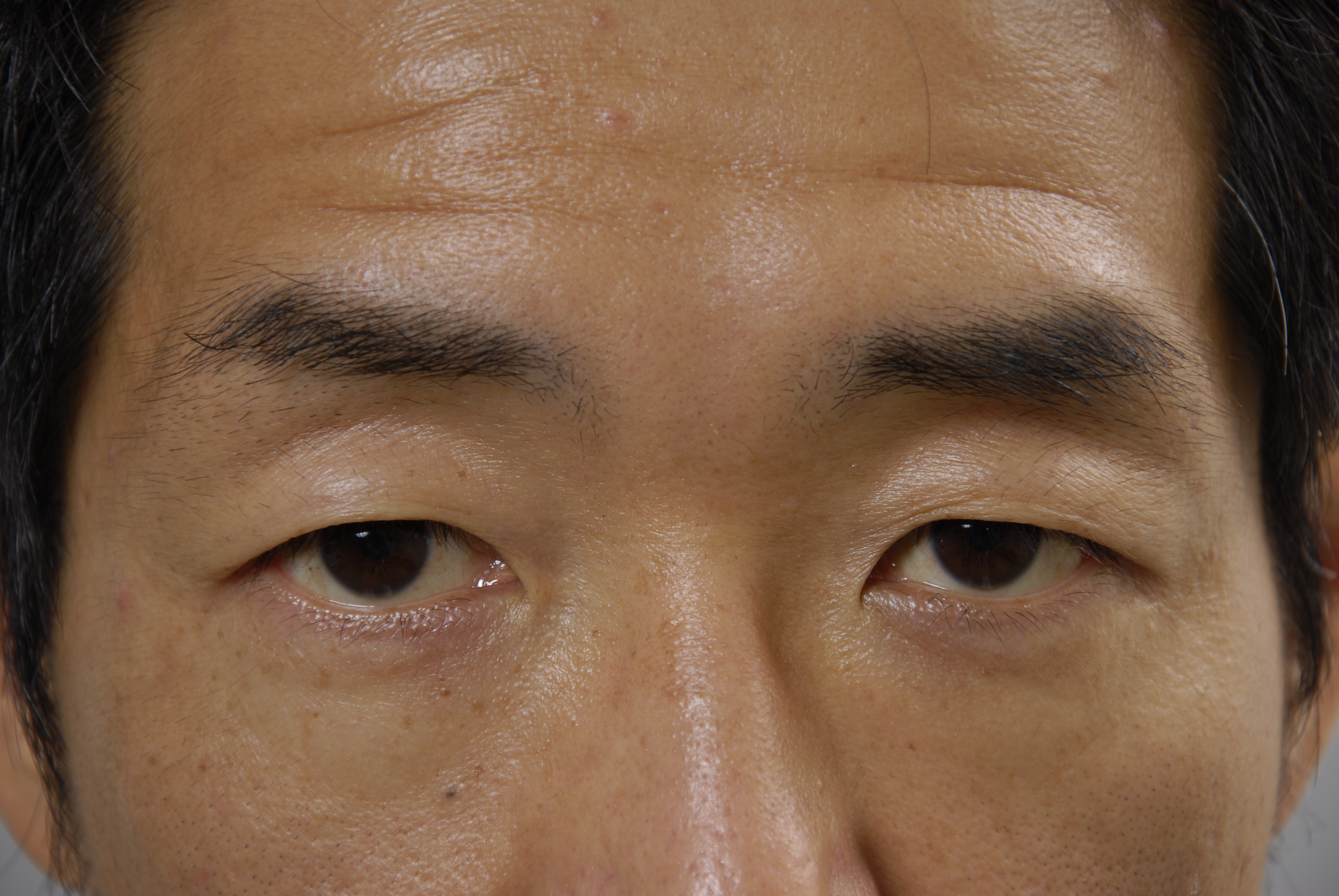 目が腫れる」原因はご存知ですか？医師が予防する食べ物も解説！ 症状の原因・病気一覧・診療科 - メディカルドック