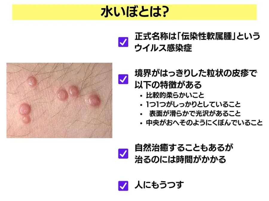 伝染性軟属腫 みずいぼ