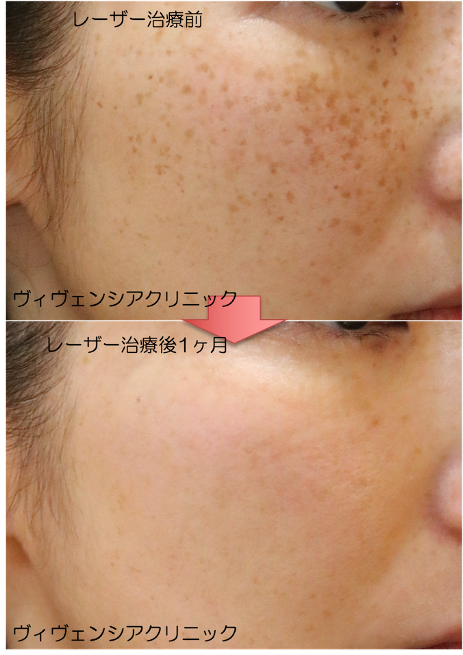 しみ治療後の経過・アフターケアについて - 銀座お肌の診療所 公式