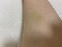 あざ 内出血 を早く治す方法を解説！治療期間や青や緑の色の違いは？ - 小林整骨院の体の悩み痛み改善コラム