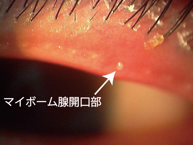 ものもらいを一晩で治す方法はある？効果的なセルフケア＆市販薬を紹介！ 薬剤師解説– EPARKくすりの窓口コラムヘルスケア情報