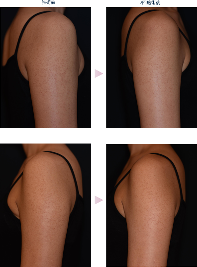 二の腕のプツプツ、毛孔性苔癬治療✨ 立川皮膚科クリニックニキビ、シミ、赤ら顔の治療美容皮膚科