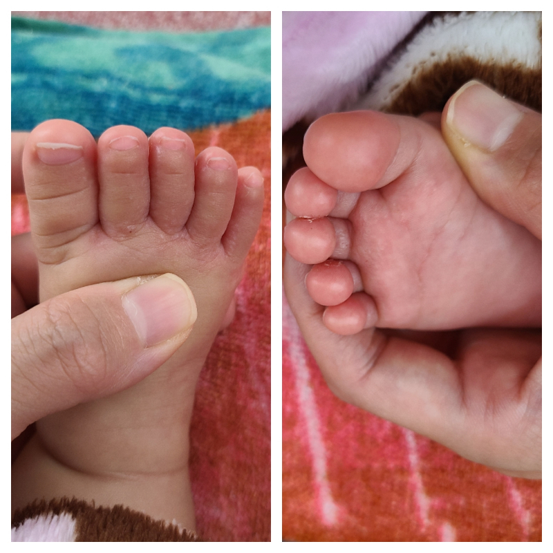 足うら汗疹TikTok