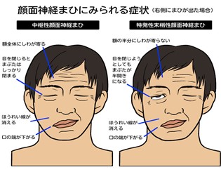 夏に多い「脳梗塞」。特有の兆候に気付いたら早急受診を。せいてつLab社会医療法人 製鉄記念八幡病院