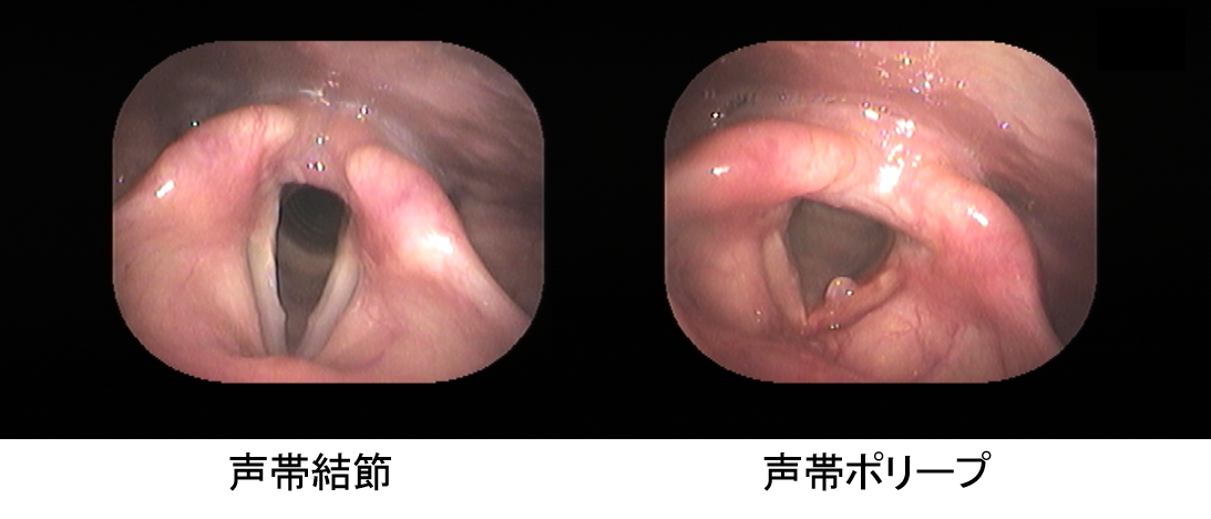 ３．眼で見るのどの病気の紹介