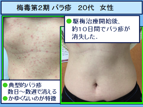 梅毒症状 写真 と感染経路・検査・治療池袋マイケアヒルズタワークリニック