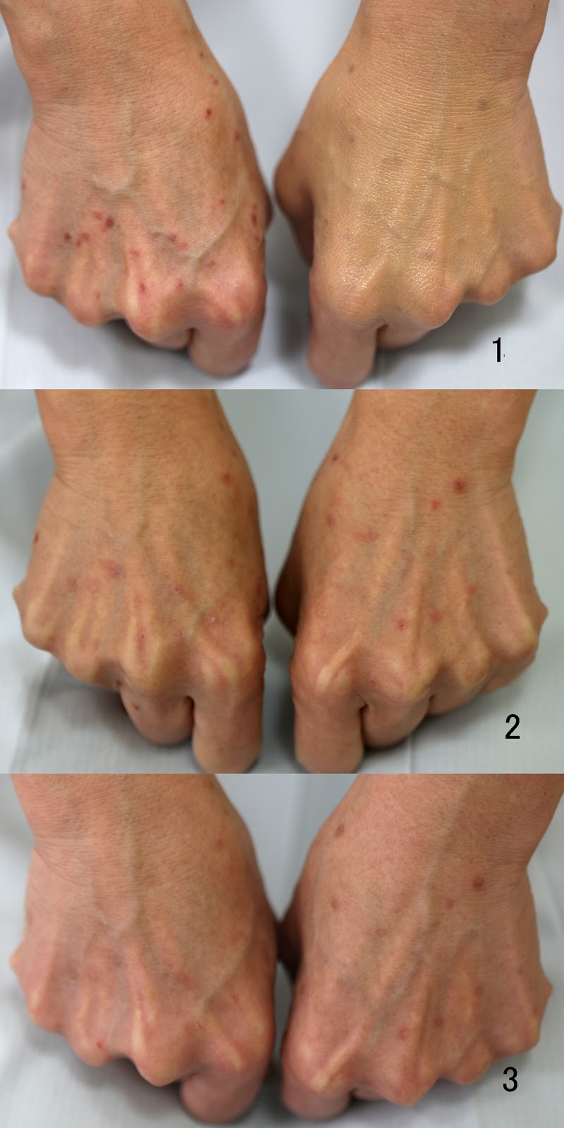 シミ取りレーザー後かさぶたにならないのはなぜ？黒いままは失敗なのか解説梅田すずらんクリニックブログ