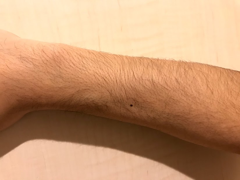 男性にも腕毛脱毛はおすすめ！メリットや施術方法、必要な回数をまとめて解説│メンズジェニ