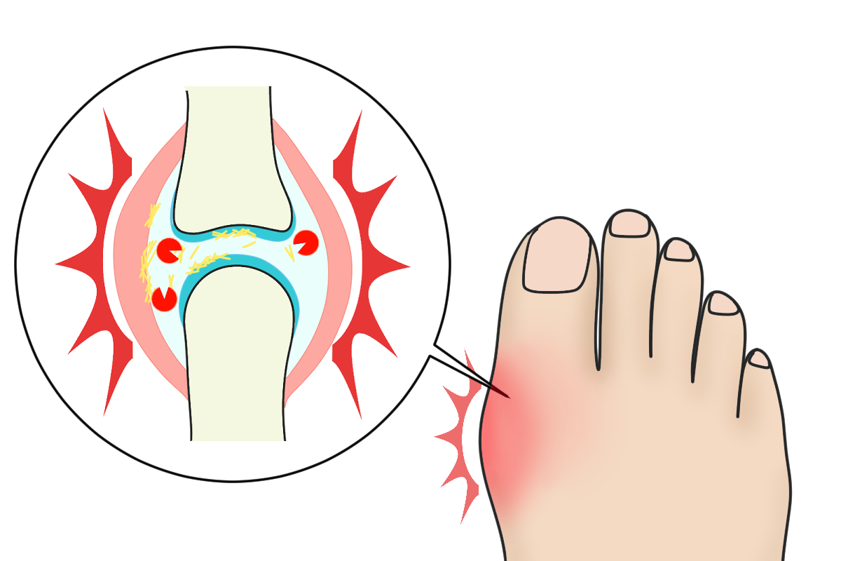 痛風尿酸値の異常が心配な方は、吹田市のいさか整形外科まで