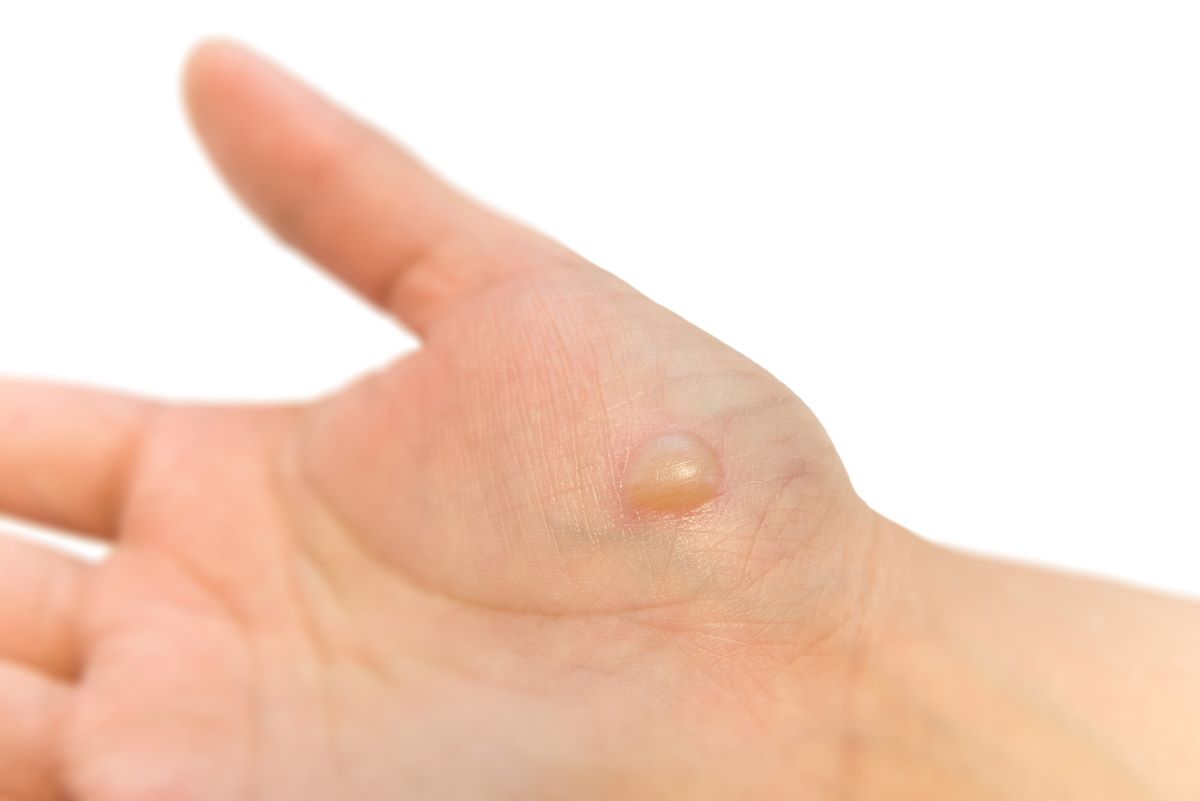 やけど』でできる水ぶくれの対処法は？潰してもいい？治療法を解説田辺三菱製薬ヒフノコトサイト