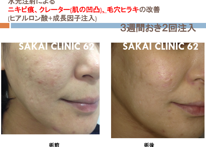 銀座の美容外科 ほうれい線にニキビ？ニキビ跡の改善方法フォーシーズンズ美容皮膚科クリニック