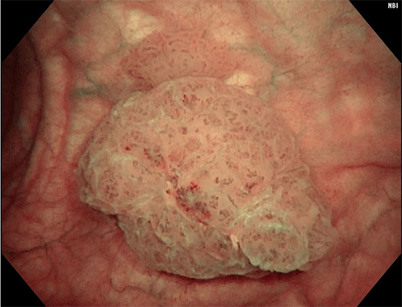 膀胱がん東京泌尿器科クリニック上野
