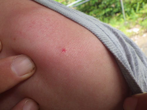 ハチに刺されました - 宿六日記－松之山温泉 和泉屋Official Blog