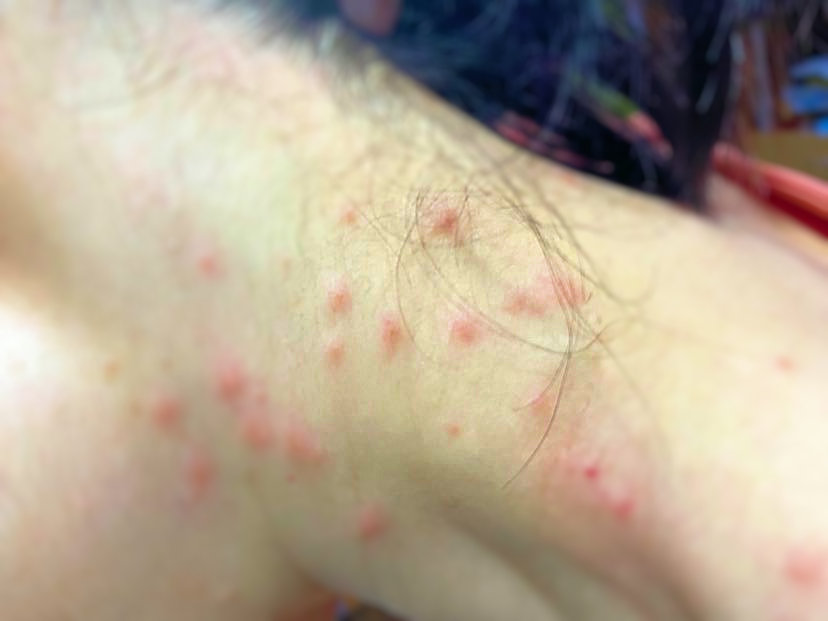 あせも 汗疹 の治し方とは？原因・予防法など解説ヒロオカクリニック
