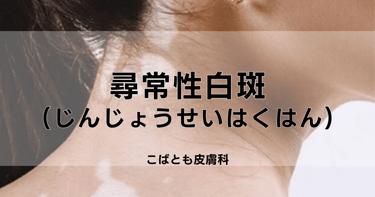 一般皮膚科：白斑 はくはん 平岡皮膚科スキンケアクリニック札幌市清田区