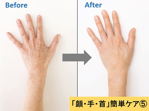 症例写真 手の甲のシミ治療の症例：美容外科 高須クリニック