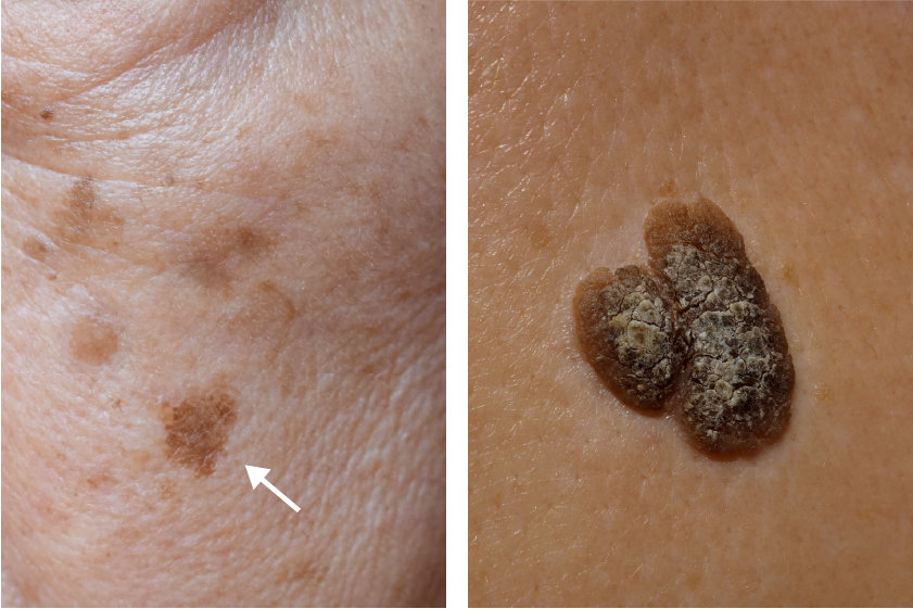 いぼ大田区大森・大木皮膚科 尋常性疣贅・イボ治療専門外来