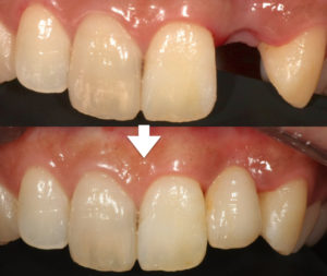 矯正治療日記南千住の矯正歯科 南千住小児歯科矯正歯科 土日診療南千住の矯正歯科専門医院 南千住小児歯科矯正歯科