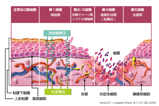 口内炎 - Wikipedia