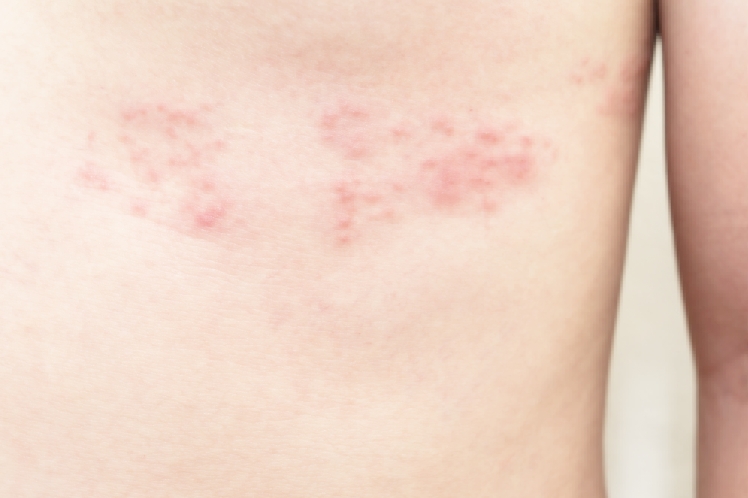 帯状疱疹とは？症状や原因を徹底解説！こんな初期症状に注意！ 医師監修- オンライン診療ならウチカラクリニック