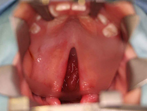 出産時に初めて、赤ちゃんが口唇口蓋裂であると判明。→「やばい 」娘の顔を見た夫の ベビーカレンダ