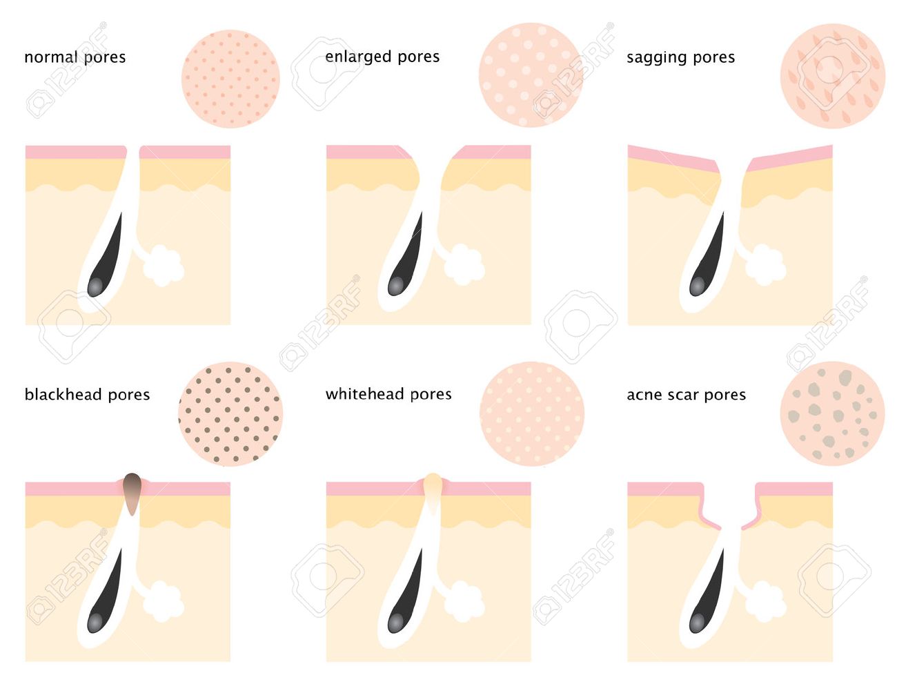 毛穴の構造 角栓 進行図のイラスト素材24669782- PIXTA