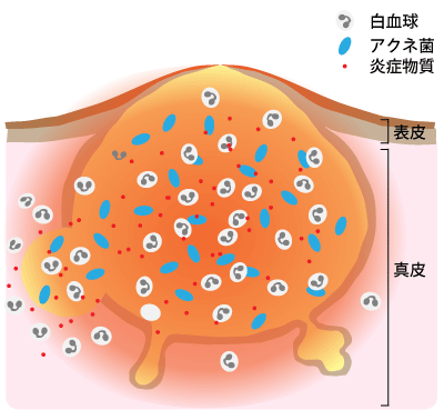 白ニキビ ニキビ 断面図 図解のイラスト素材 - PIXTA