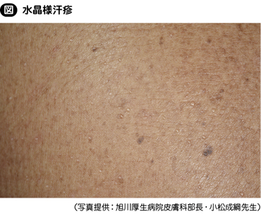 汗疹 あせも とはメンズスキンケア大学