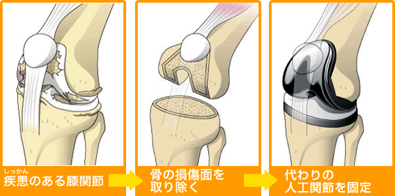 人工股関節置換術 THA 後の禁忌肢位を示したイラスト🎨 フリー素材 看護roo! カンゴルー