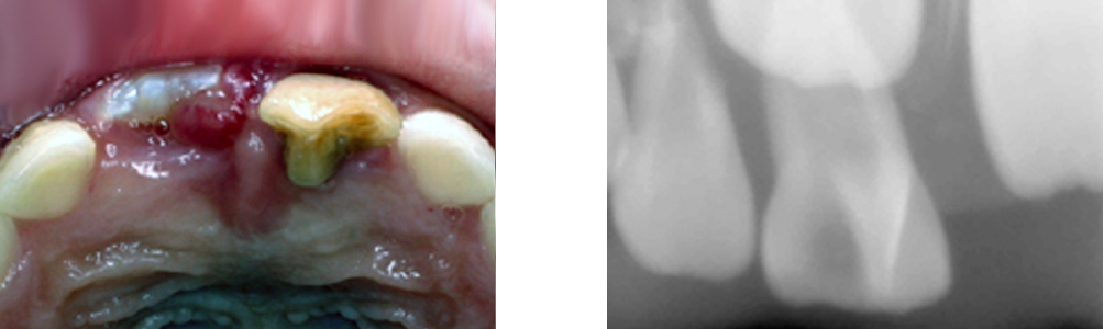 歯の本数が多い？過剰歯が見つかったら、抜かなきゃいけないの？ – さいたま市岩槻区審美歯科のスワンデンタルクリニック
