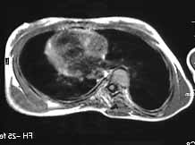 せぼねの曲がり”外科 群馬脊椎脊髄病センター 首の痛み・手足のしびれ・腰痛・曲がり 側弯症