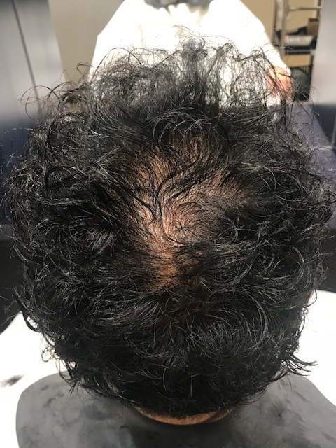 つむじはげ 頭頂部薄毛 を解説。基準や、原因と対策について - 発毛コラム薄毛改善・発毛専門のリーブ21 公式