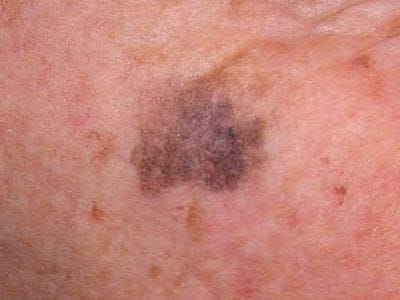 皮膚がん杉沢皮膚科クリニック