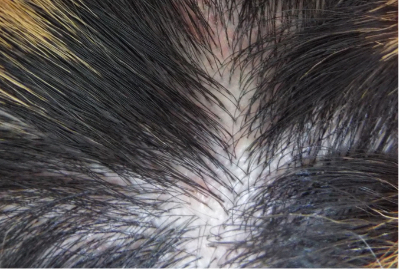 頭皮にきびの原因と対処法は？できやすい人の特徴とケア方法おとなのにきび研クラシエの漢方「ヨクイニン」 - Kracie